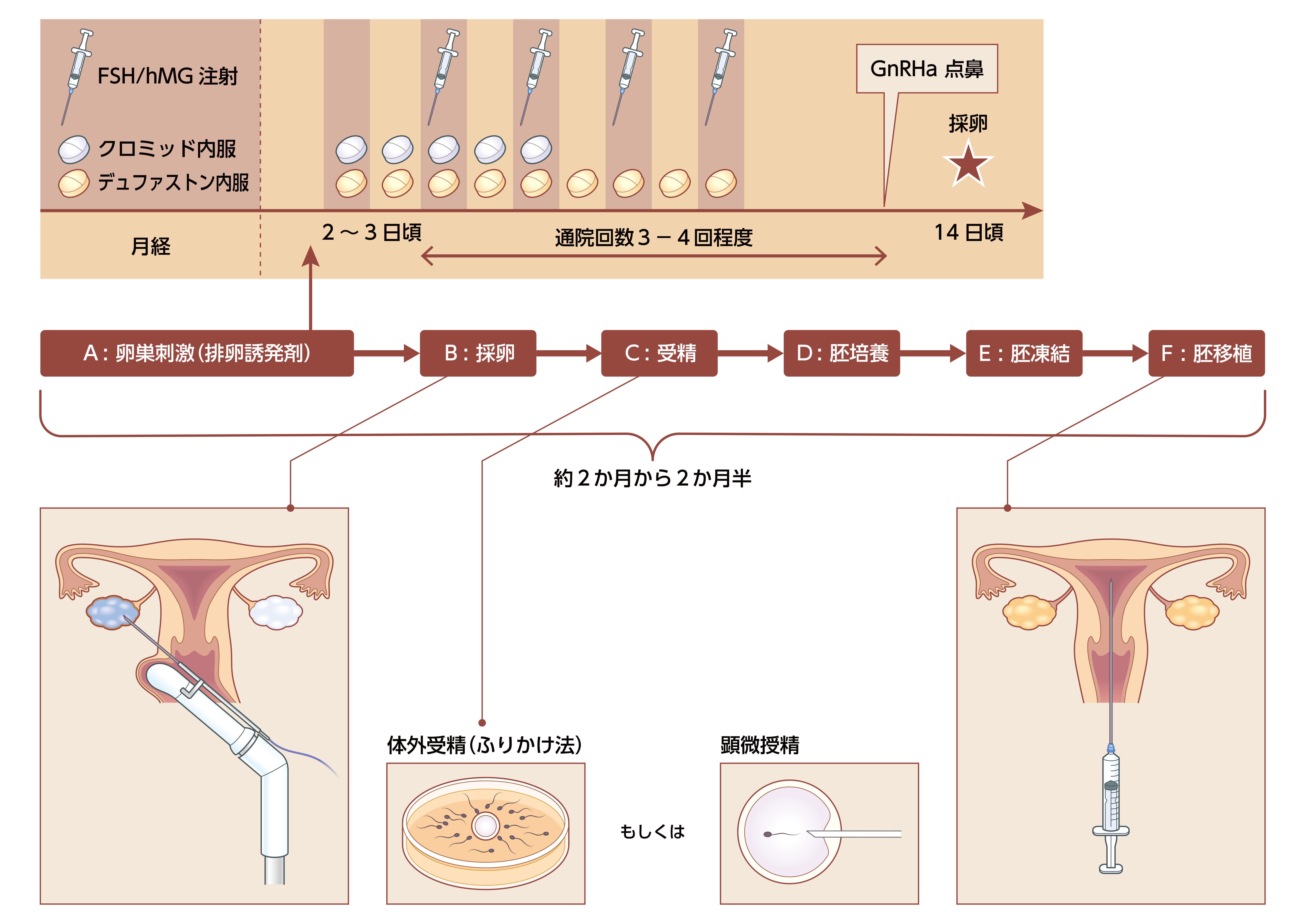IVF（体外受精）の流れについて：A卵巣刺激(排卵誘発剤)→B：採卵→C：受精→D:胚培→E：胚凍結→F：胚移植